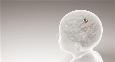 天顺：首例脑机接口设备人体移植完成